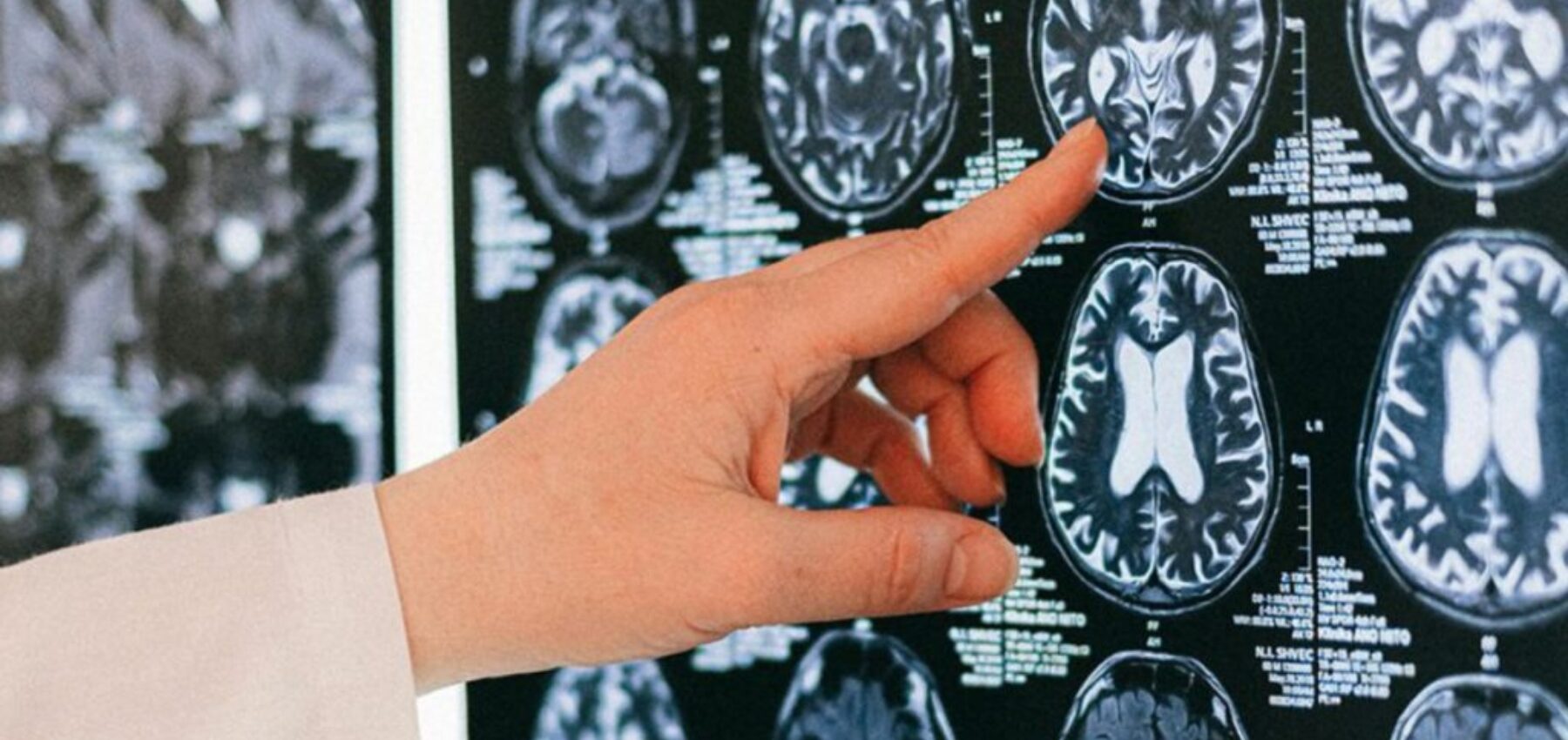 Epilepsiechirurgie stock 2025 01 07 111721 vfvh